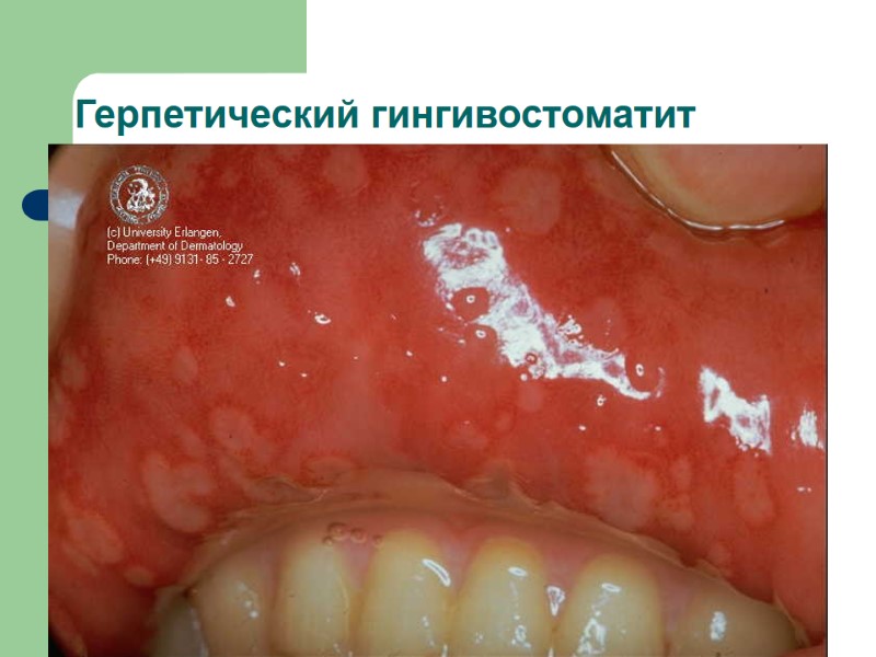 Герпетический гингивостоматит